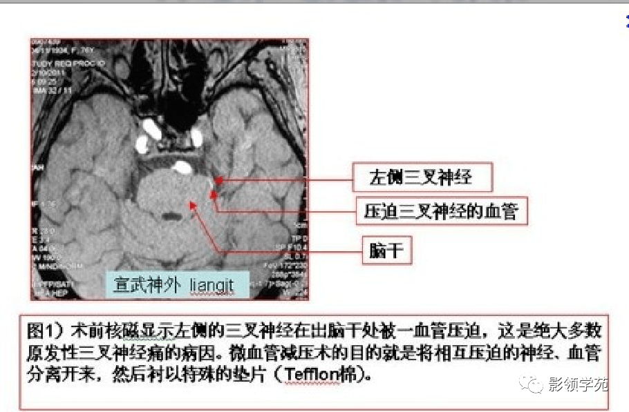 三叉神经mri报告模板图片