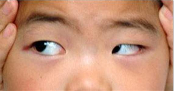 眼球震颤吃什么可以治疗,小孩眼球震颤是怎么形成的