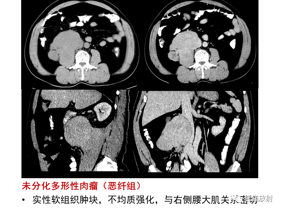 肿瘤片子图片图片