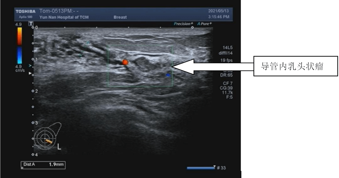 吓人的乳腺导管扩张_超声_检查_患者