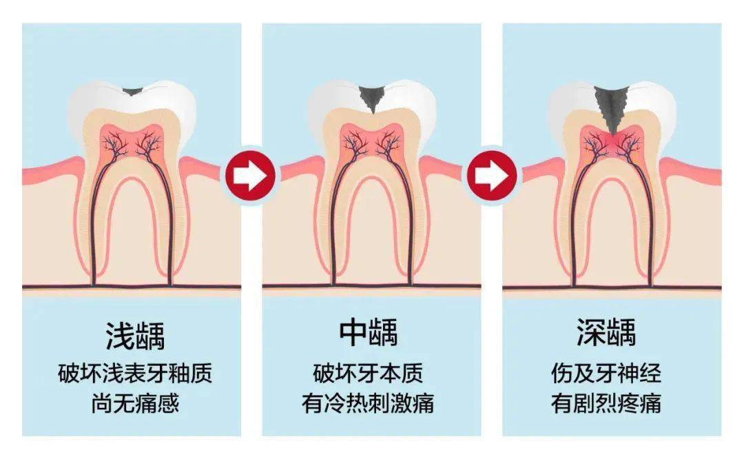 牙疼的四个等级自测一下您属于哪一种