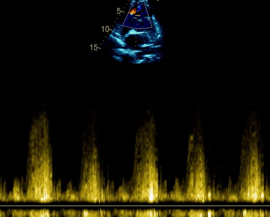 室间隔膜部瘤的超声心动图诊断