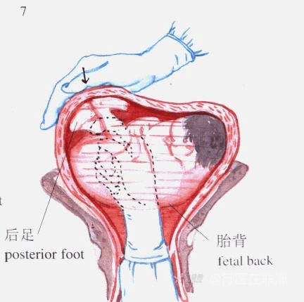 臀位剖宫产动画示意图图片