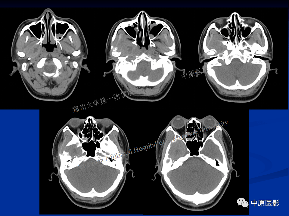 颞下窝巨细胞修复性肉芽肿_全网_影像_解剖图