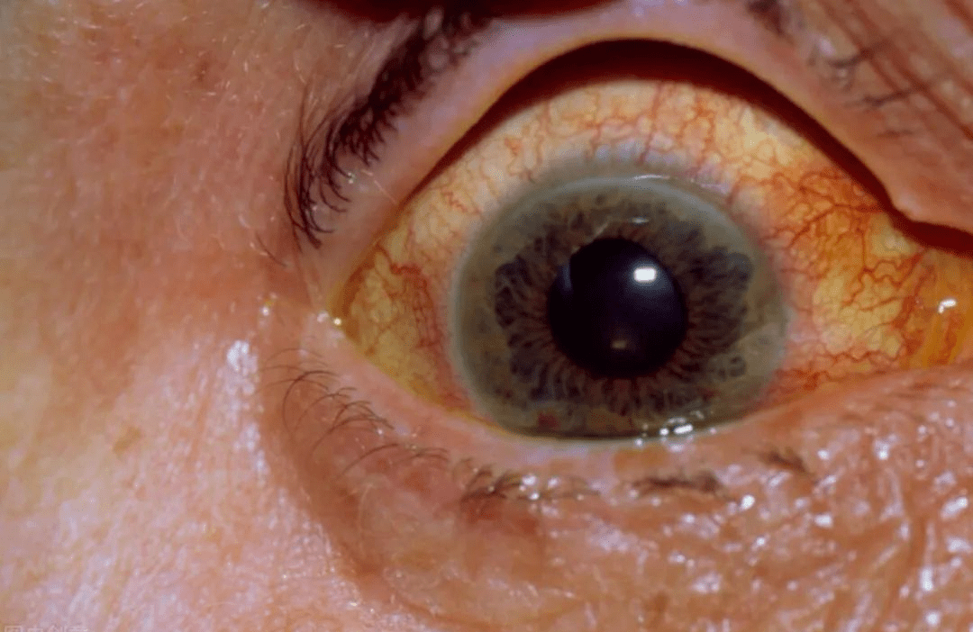 52岁男子,脑出血离世,妻子痛哭:早该控制一下的_女儿_情况_脑溢血