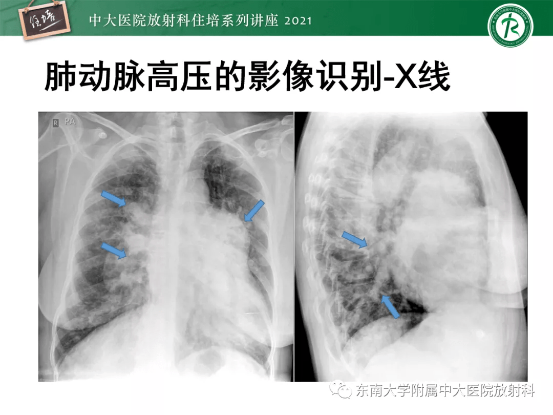 肺动脉高压的影像评估