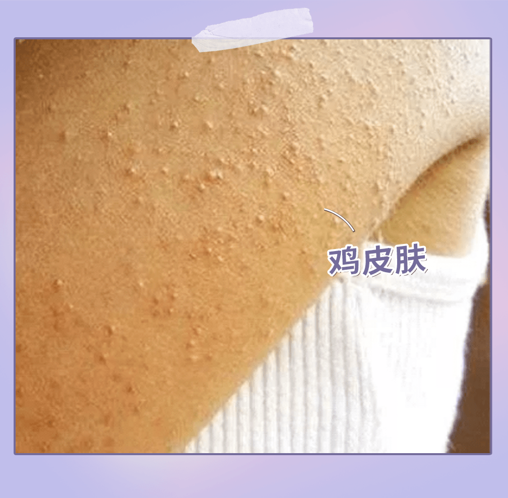 身体护理 | 简单六招,拒绝粗糙鸡皮肤!_角质_毛囊_毛孔