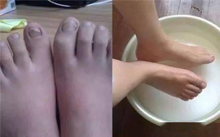 身上热脚冰凉怎么缓解 6871738c445449148ff1d35720a803d5.jpeg