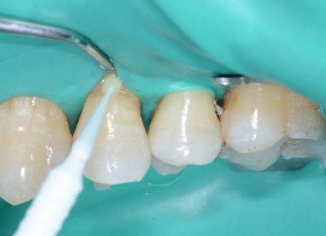 小技巧在楔状缺损充填时的应用_树脂_口腔_牙齿