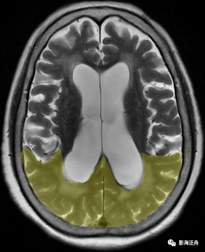 诊断|小心误诊，这可不是单纯的脑萎缩