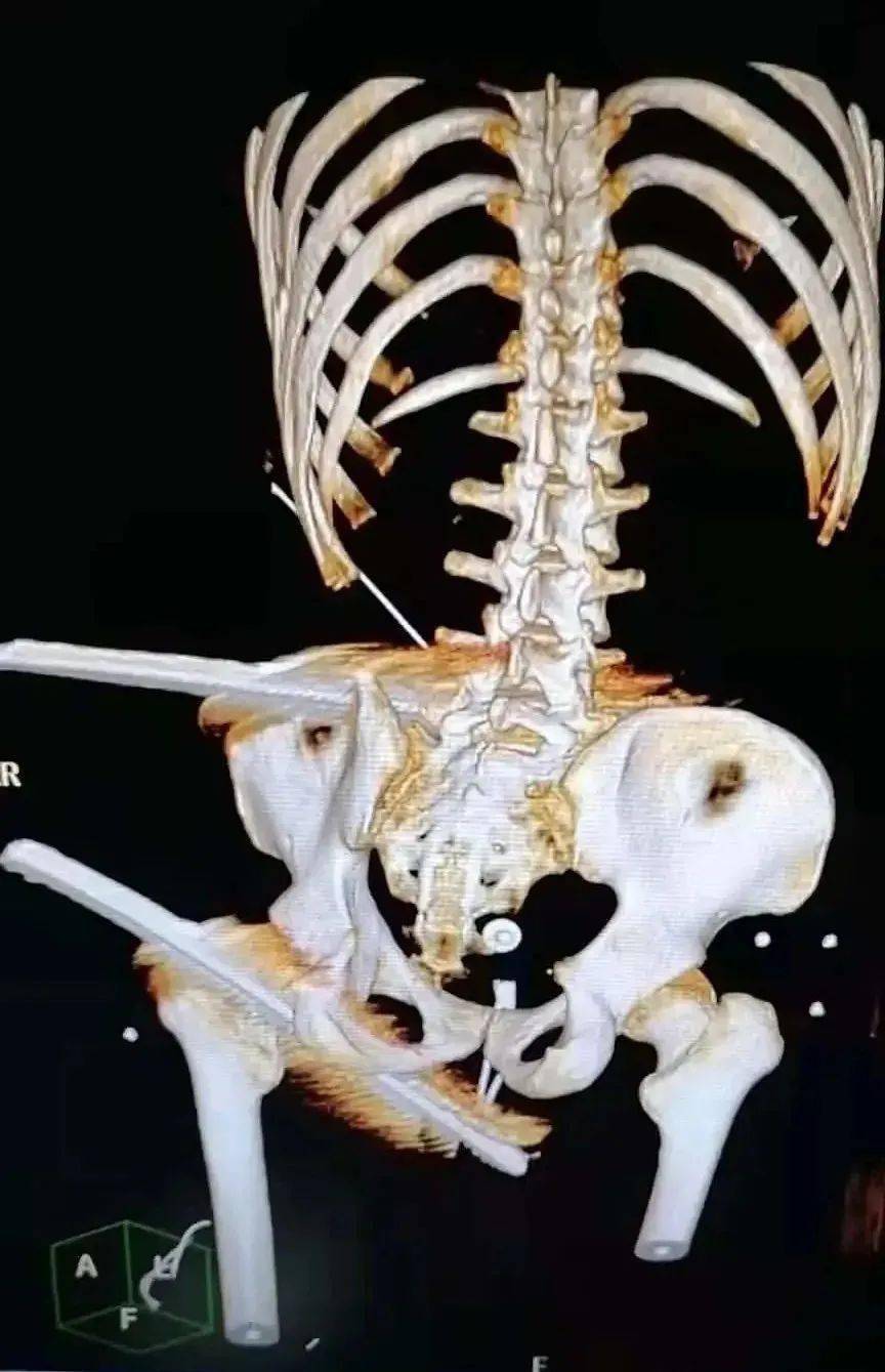 痛呀广西一男子身体被2根钢筋贯穿看着就腿软