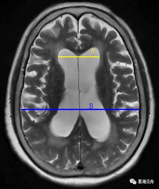 诊断|小心误诊，这可不是单纯的脑萎缩