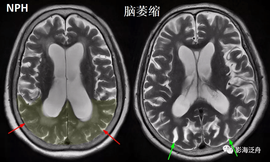 诊断|小心误诊，这可不是单纯的脑萎缩