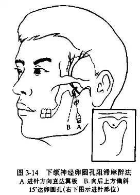 (7)下牙槽,舌,頰神經一次阻滯麻醉,亦稱下頜支內側隆突阻滯麻醉本文