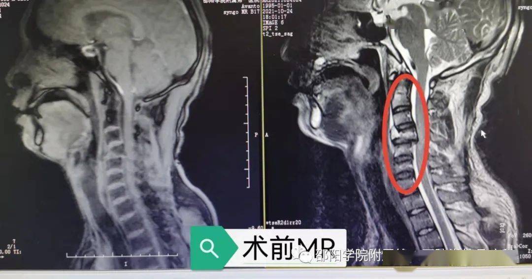 脊柱|医学有奇迹！邵阳学院附属第一医院脊柱骨病科、康复科携手让26岁瘫痪小伙再行走！