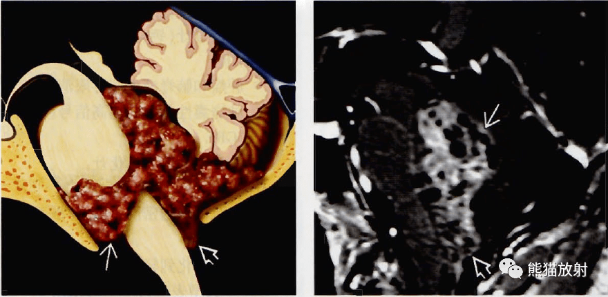 幕下幕上室管膜瘤室管膜下瘤丨影像诊断要点