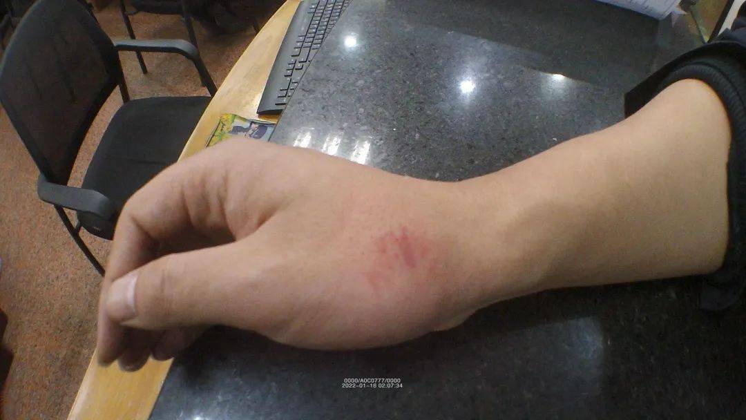 民警依法采取强制传唤措施,郭某恼羞成怒用嘴撕咬民警,辅警手臂,并