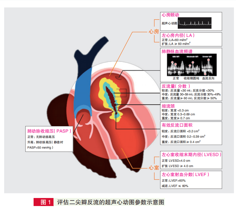微创治疗二尖瓣反流mitraclip十大建议阜外医院潘湘斌等牵头亚太共识