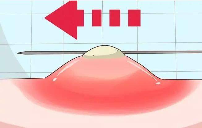 因为粉刺痘痘能挤吗？