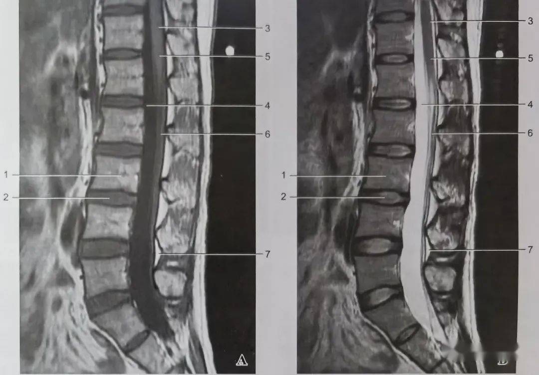 正常胸腰椎的mri解剖
