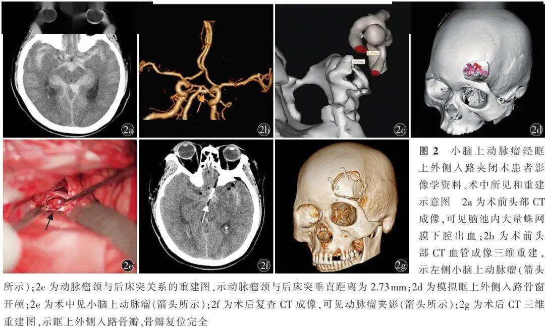 张鸿祺|中国脑血管病 | 眶上外侧入路夹闭后循环动脉瘤七例并文献复习