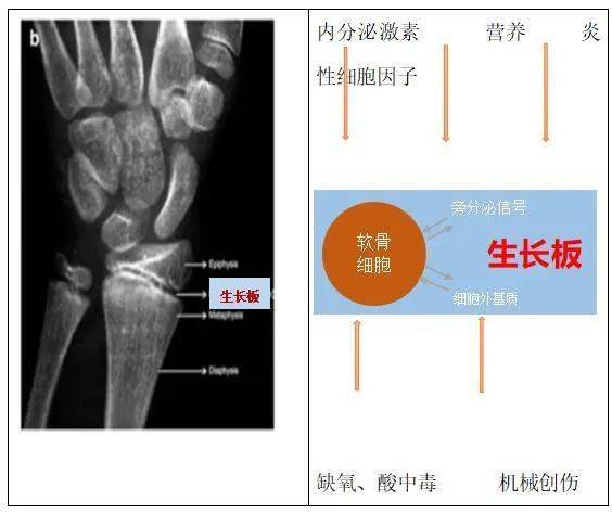 骺板和骺软骨图片