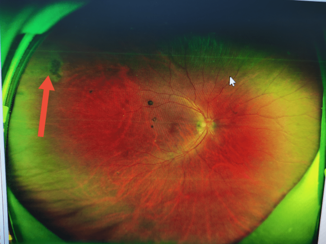 惊年前大扫除长沙阿姨用力过度竟导致视网膜脱离