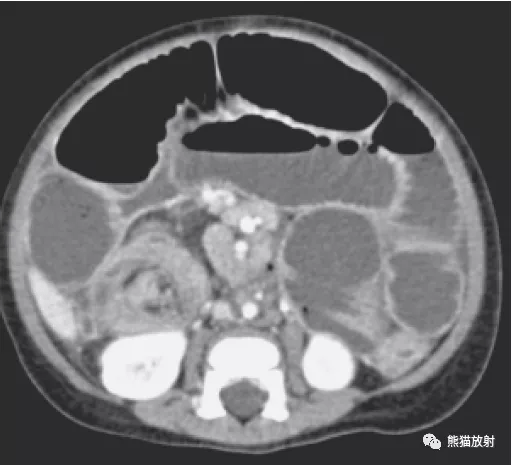 肠系膜|非外伤急腹症丨相关影像图例