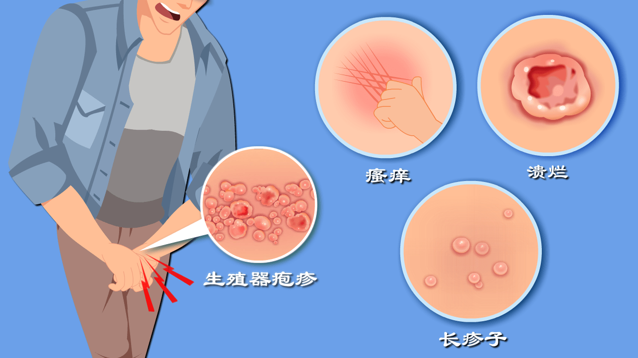 私处长疹子 瘙痒 生殖器疱疹发病率逐年上升 这些症状你有吗 水疱 治愈 患者