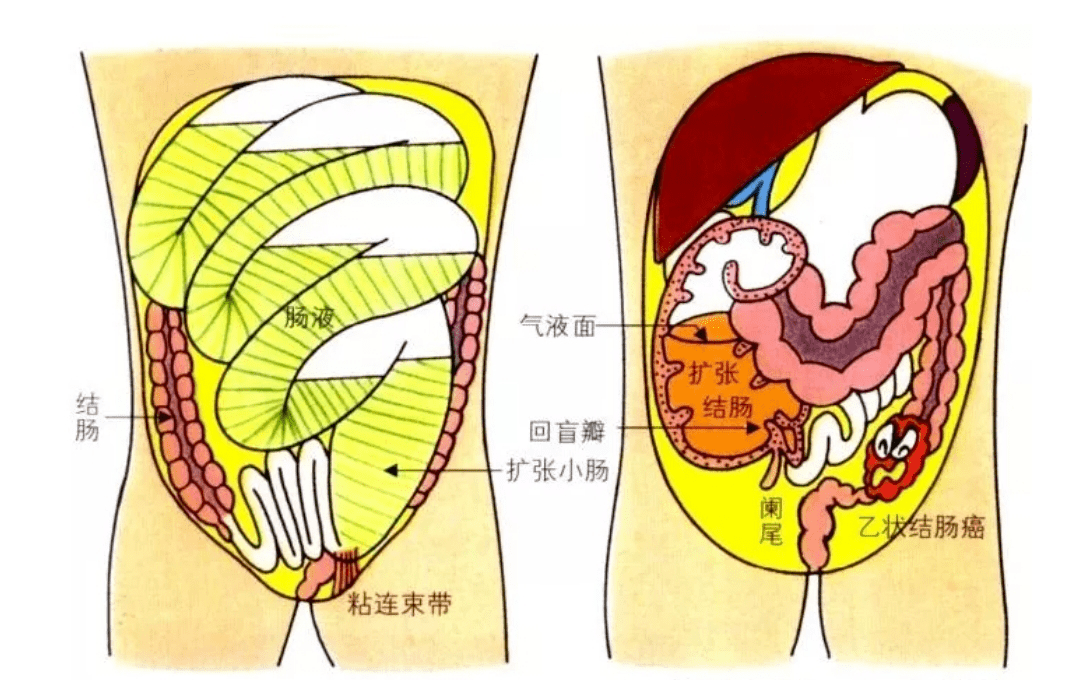 春节健康系列科普丨不同寻肠,与您一起认识肠梗阻