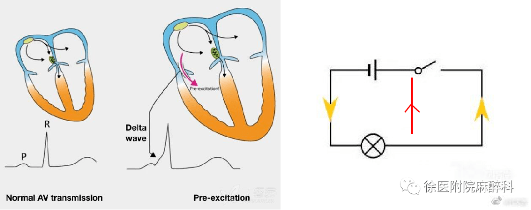 预激综合征的麻醉管理_心电图_旁路_窦性