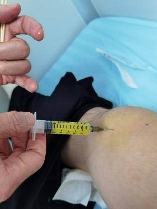 根据以往经验,关节腔的积液由于腔内压力大,抽满关节液一针管,更换