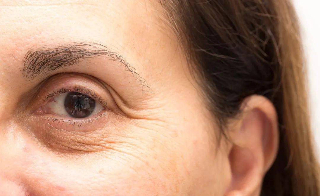 较多见于中老年人.松弛型眼袋2下眼睑眶隔筋膜脂肪膨大,突出于眶外.