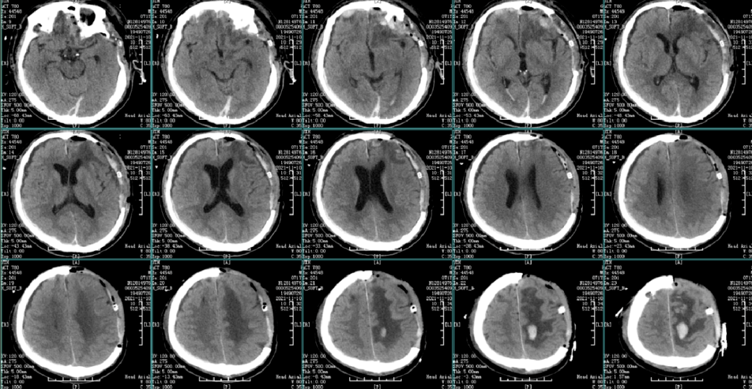 11月9日,患者昏迷,意識障礙較前明顯加重,gcs下降至6分,複查ct提示腦