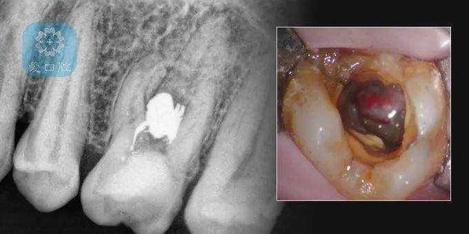 牙髓底穿孔图片