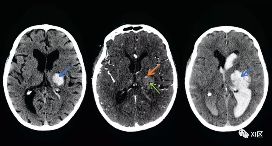 ct图像中脑出血血肿扩大的十个征象(下)_al_sign_et
