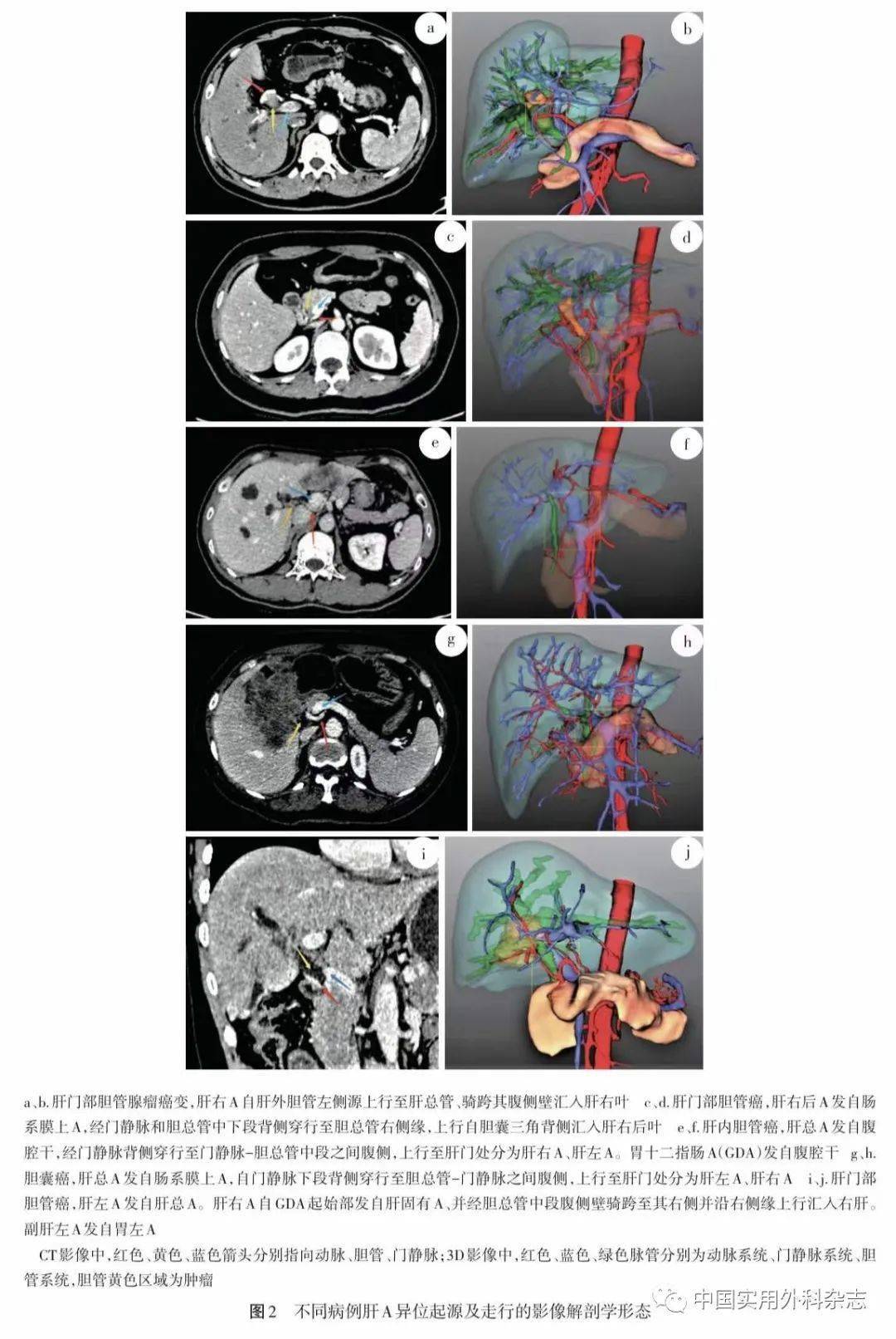 论著352例胆道疾病病人腹腔干肠系膜上动脉系统影像解剖学研究及其