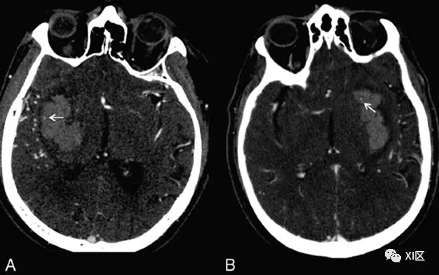 ct图像中脑出血血肿扩大的十个征象(下)