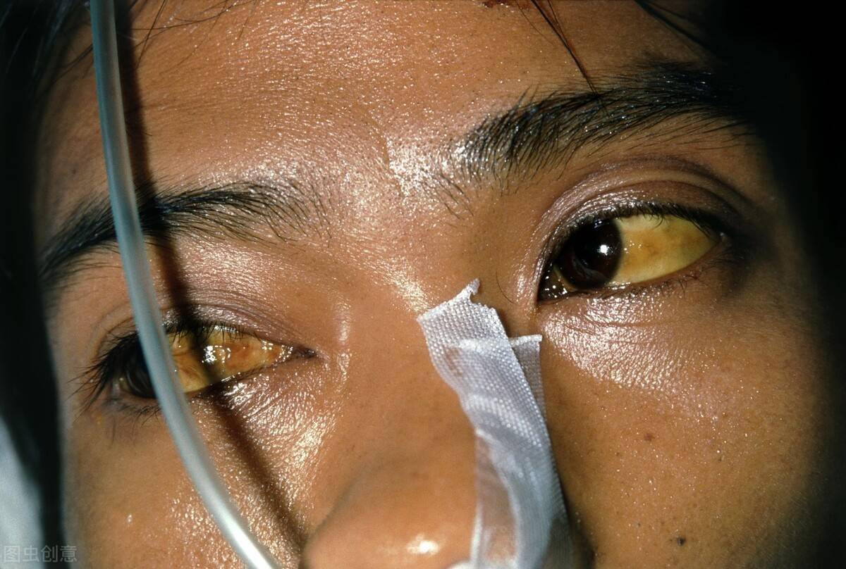 肝病黄疸眼睛图图片