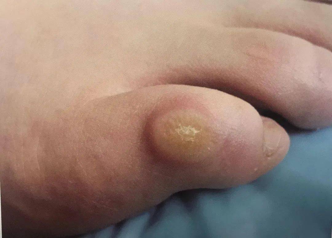 不懂就问脚上长的这种像鸡眼的疙瘩是什么
