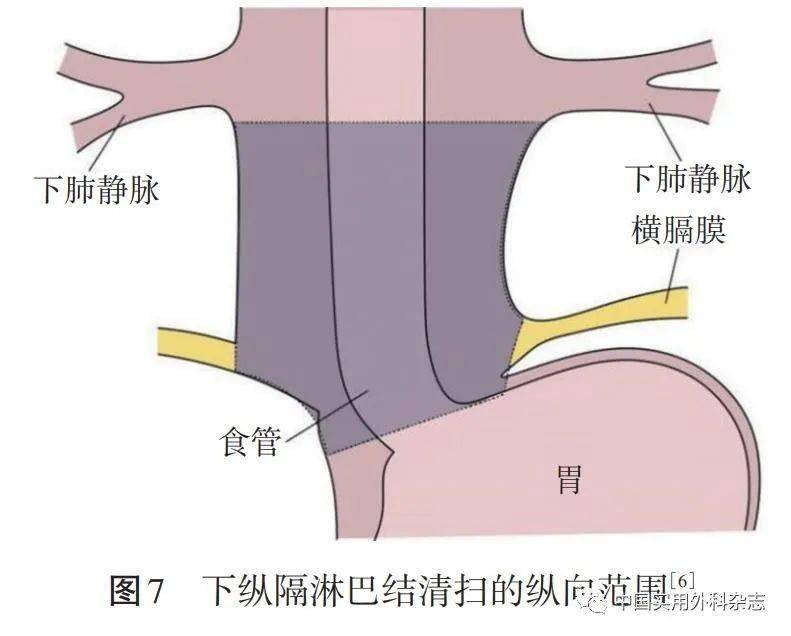 論著經食管裂孔下縱隔淋巴結清掃在siewertⅡ型食管胃結合部腺癌根治