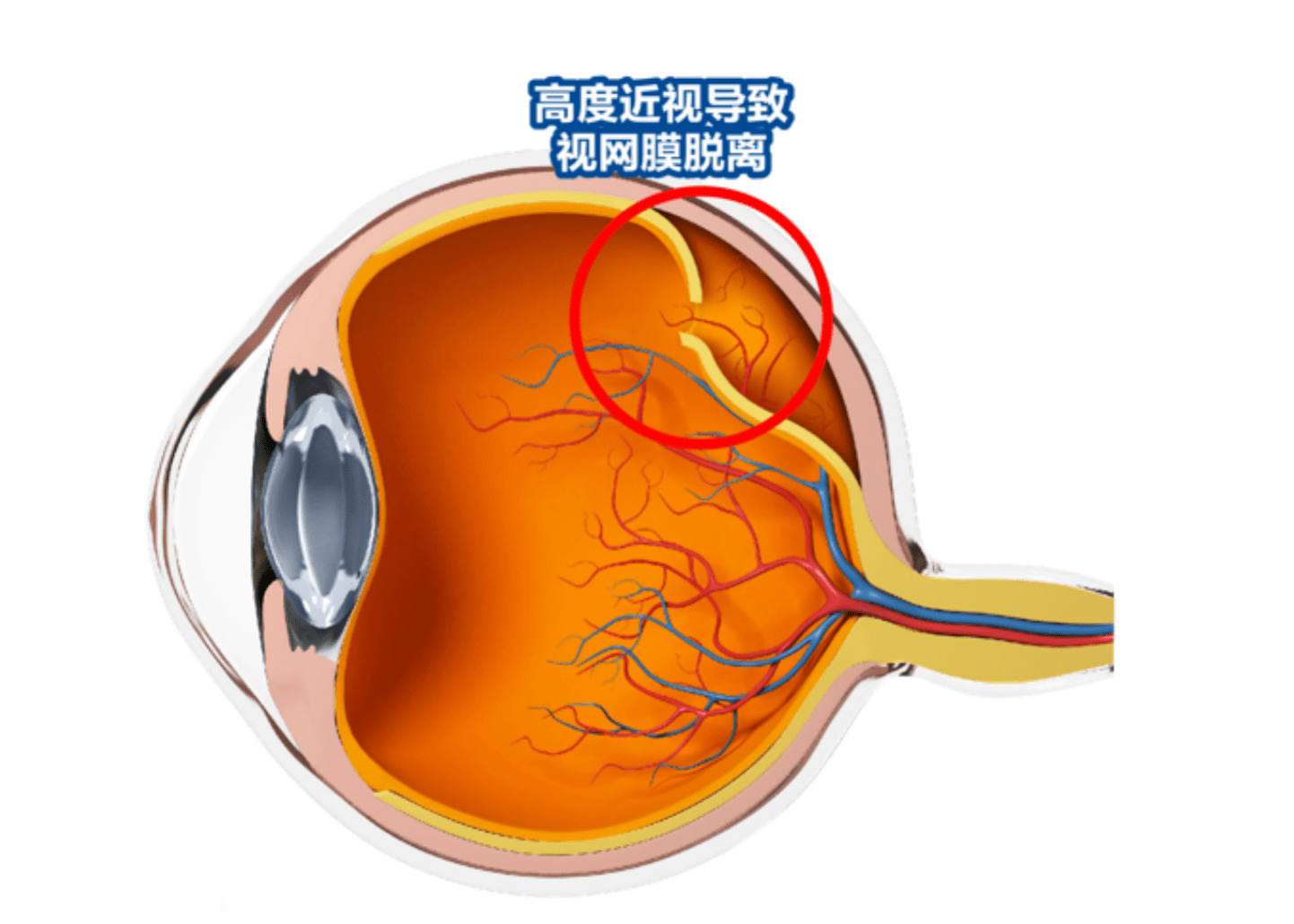 廣州男子眼前突然一片黑竟是視網膜脫離