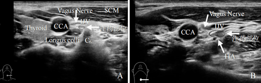 星状神经节阻滞超声图图片