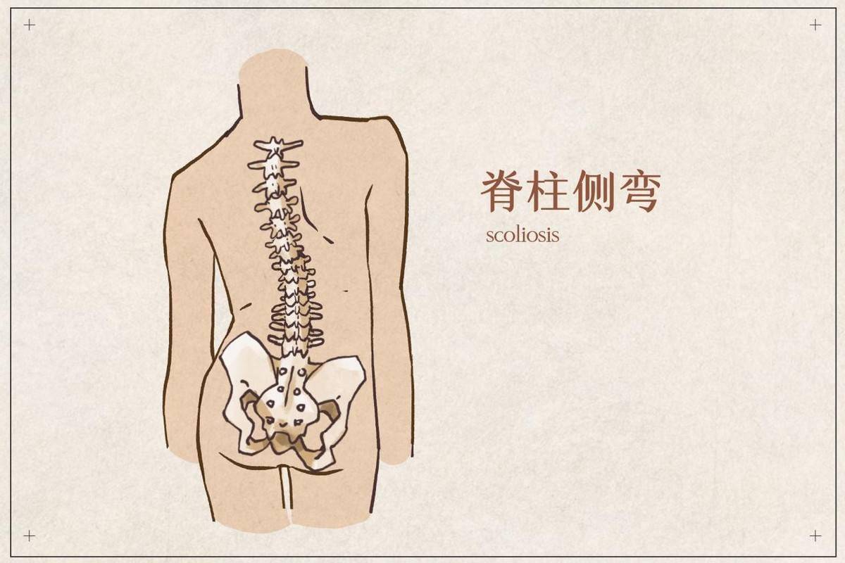 90歲老人的腰椎是什麼樣退變性脊柱側彎需要警惕