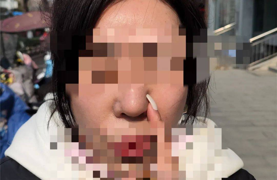 向医生徐州女子花三万多隆鼻，鼻子没“翘”？