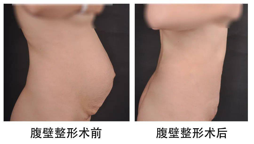 腹壁整形术适合腹直肌分离症伴腹壁组织松弛者,通过手术的方式将中下