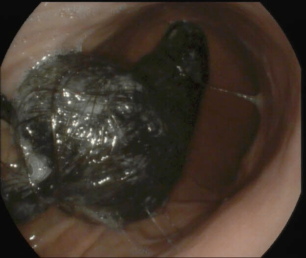 5岁女孩脱发头发居然跑进了胃里