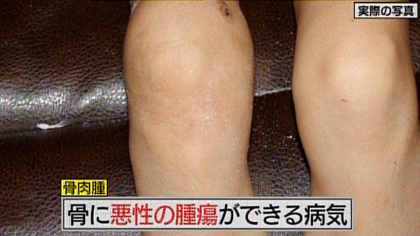罕见病骨肉瘤的分类、症状、诊断、治疗介绍
