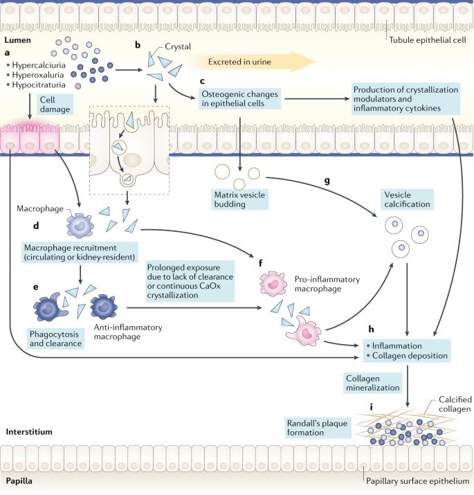 晶体|Randall斑与草酸钙结石形成：对免疫和炎症的作用