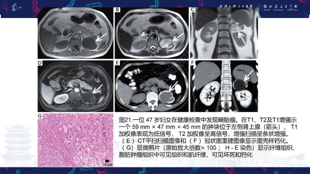 肾上腺常见病变ct及mri诊断